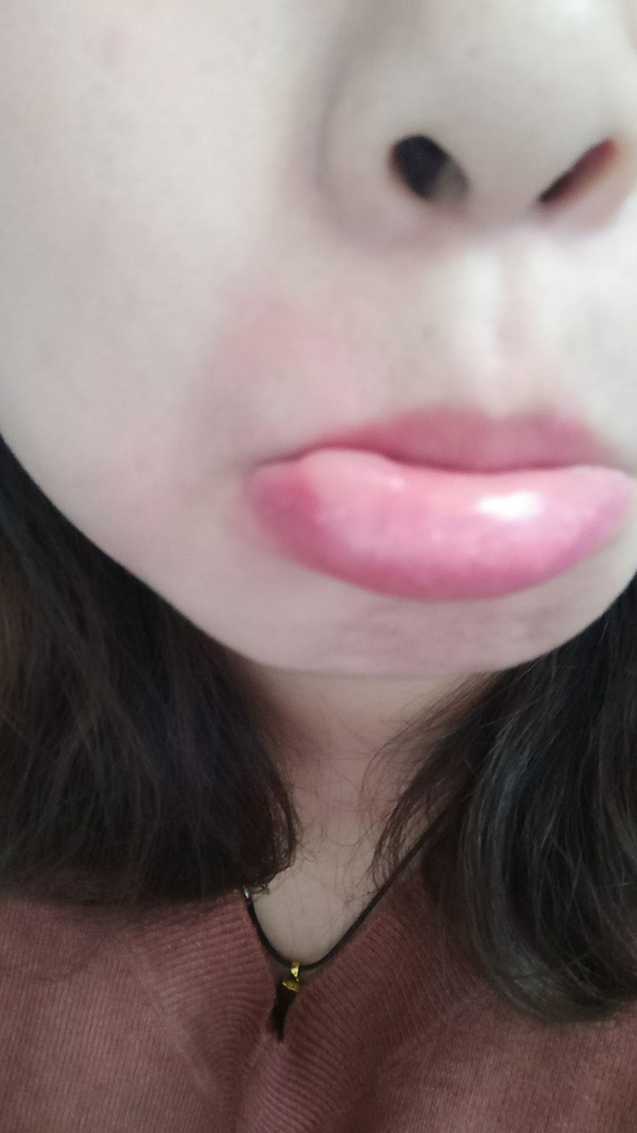 为什么嘴唇被蚊子咬了会肿的很厉害而且迟迟不消肿