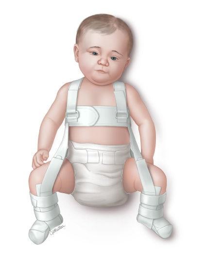 宝宝八个月先天性髋关节脱位有没有类似治疗经验分享