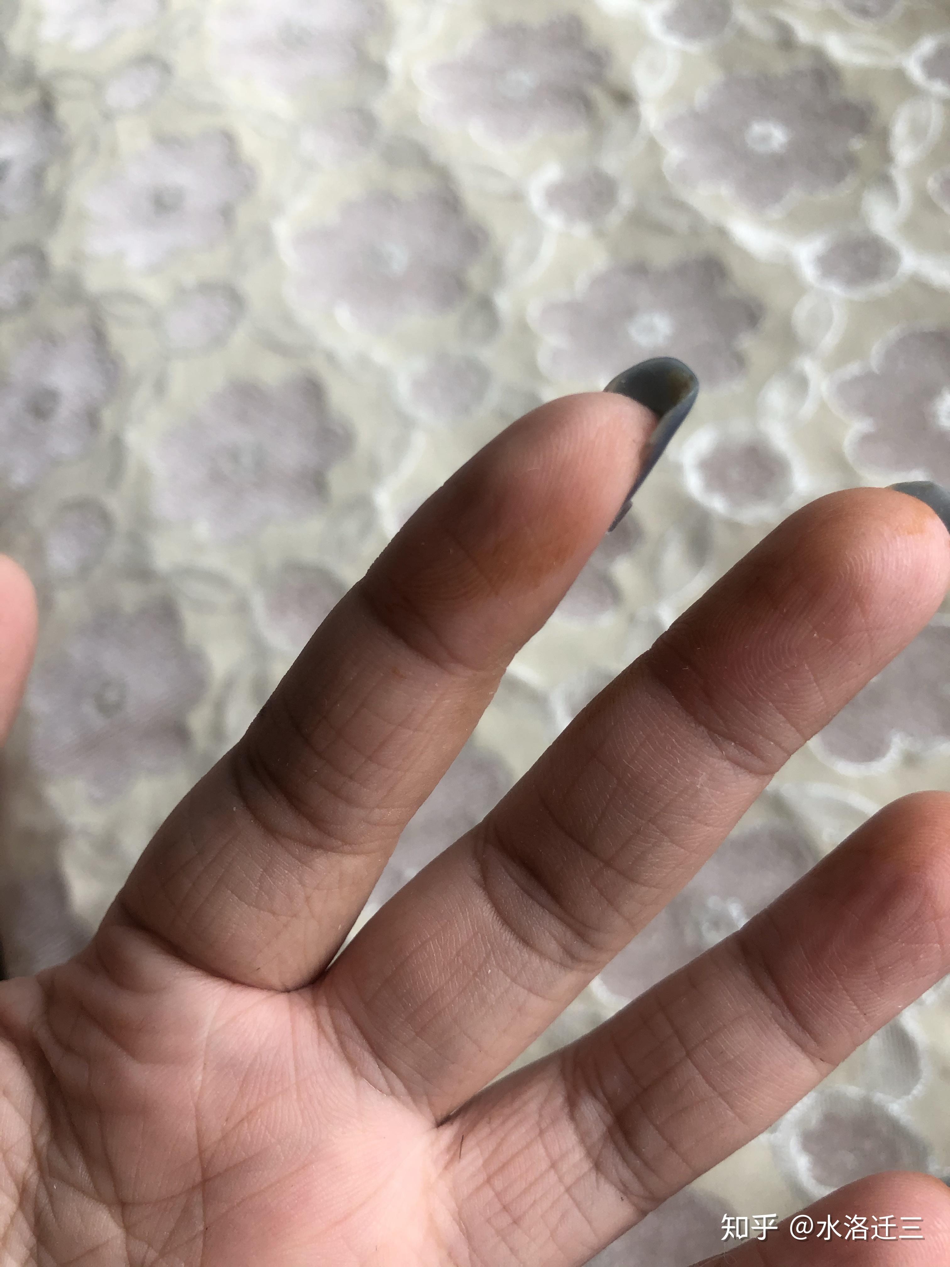 一觉醒来手上有铁锈一般的黄色块洗不掉