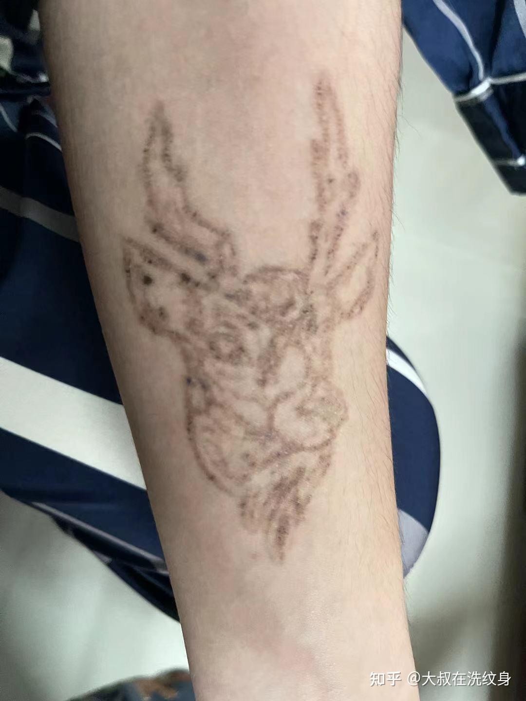 四个月能洗掉10cm左右的纹身吗