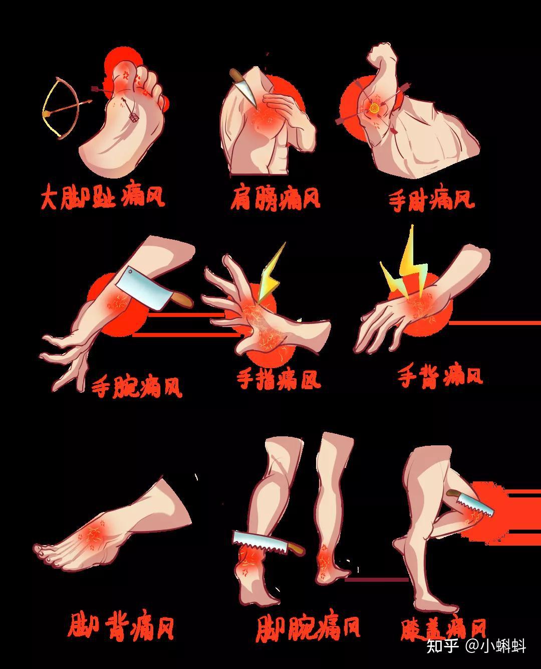 从足部到全身痛是痛风引起吗? - 知乎