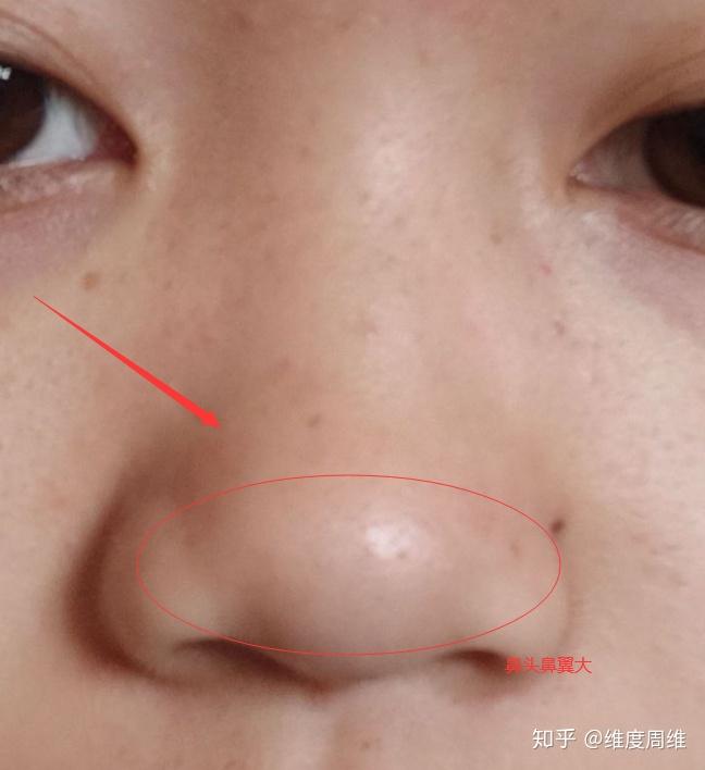 鼻子塌山根还低怎么办