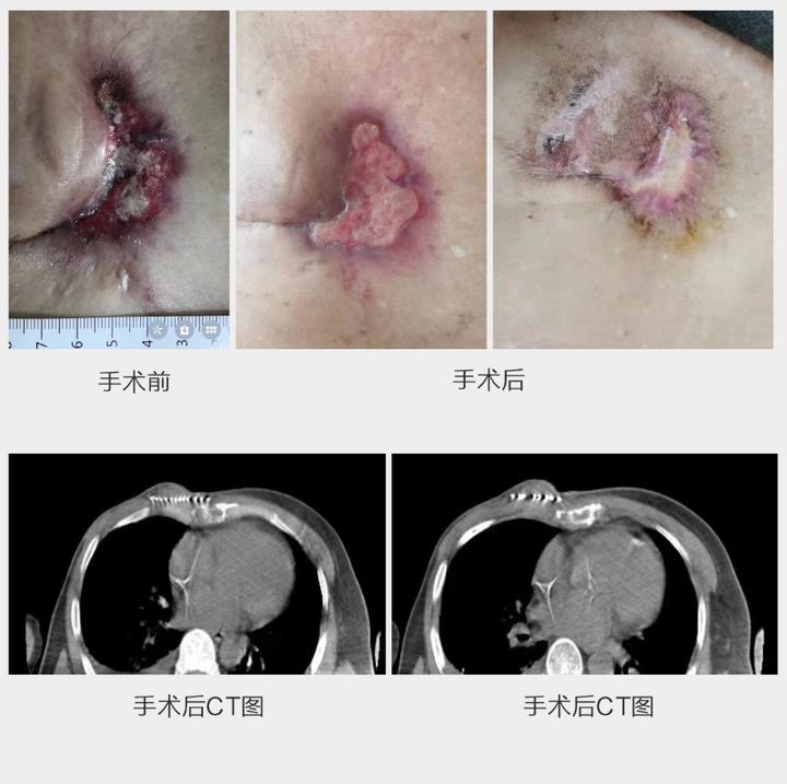 小粒子大作为乳腺癌术后胸壁复发患者的康复之旅