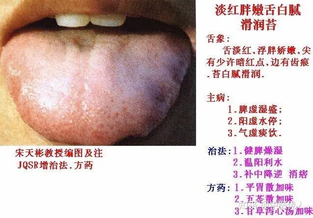 高清舌诊图解:各种临床证型舌象图谱大开眼界 - 知乎
