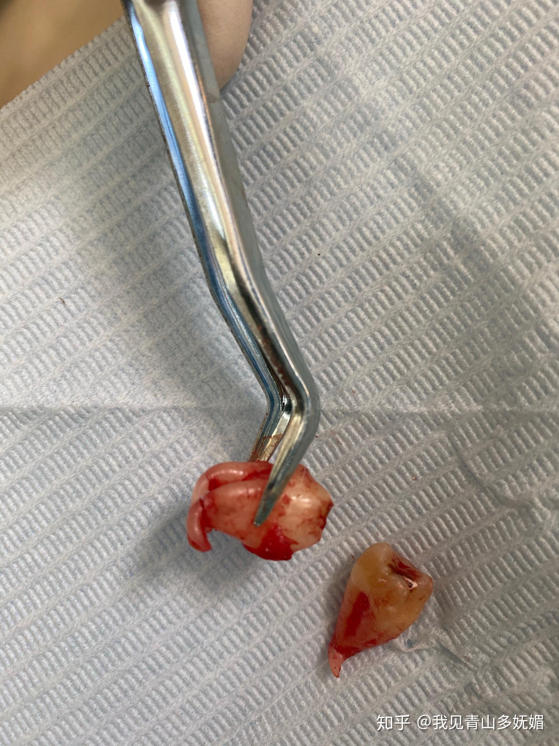 请问智齿牙根是弯的好拔吗