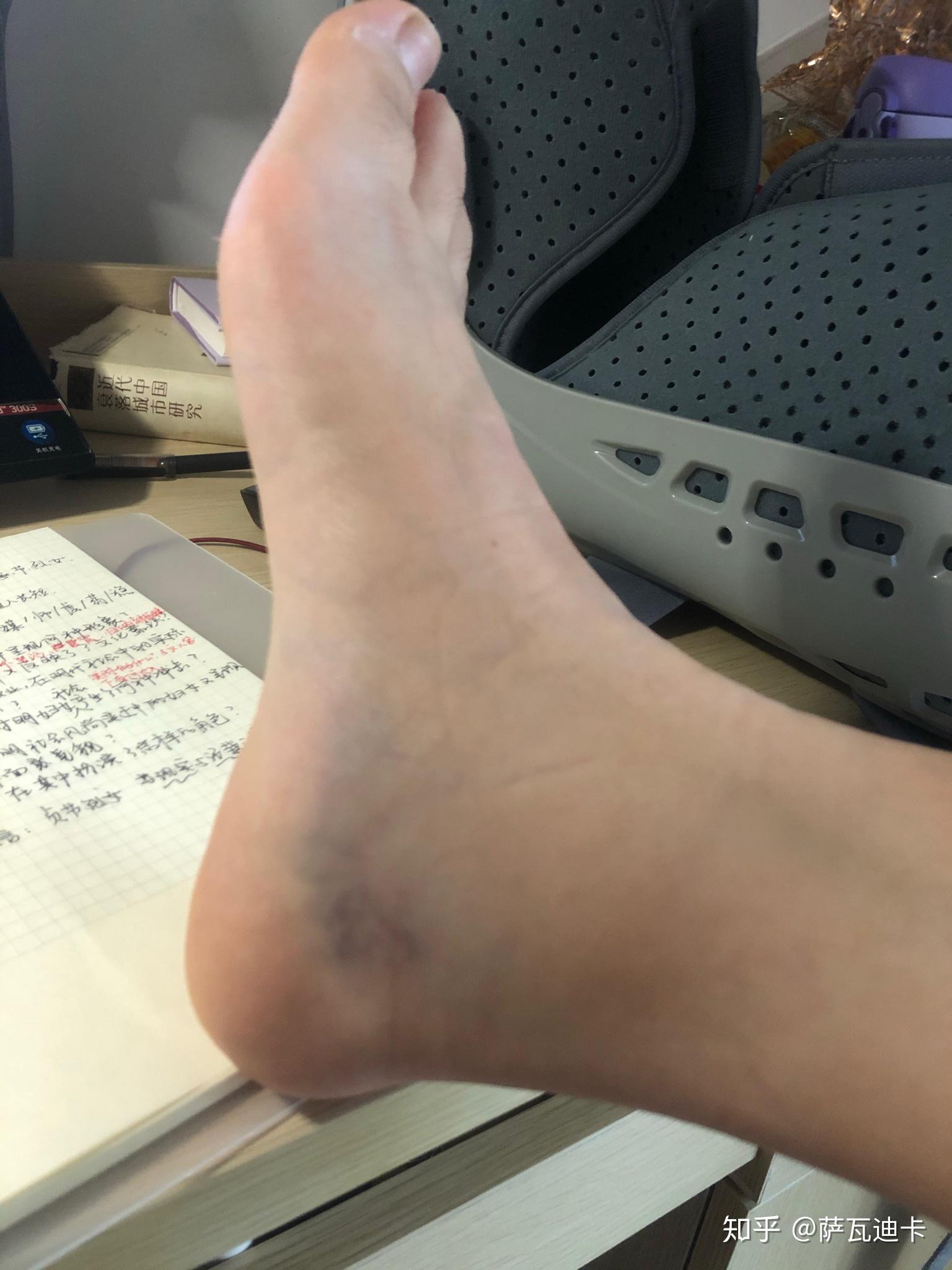 右脚踝轻微骨折大概多久能好平时要怎么坐