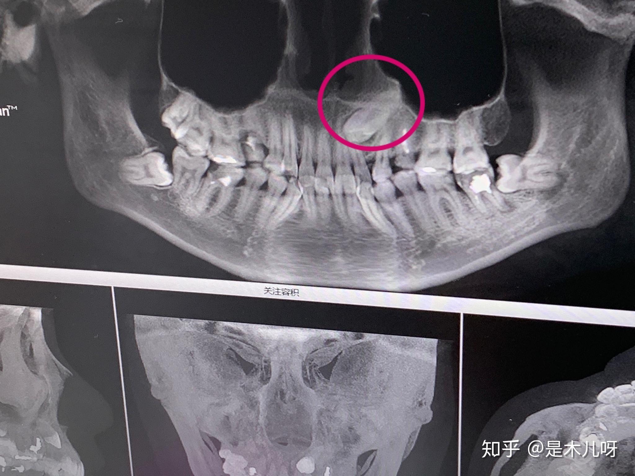 智齿横着长是一种怎样的体验? - 知乎