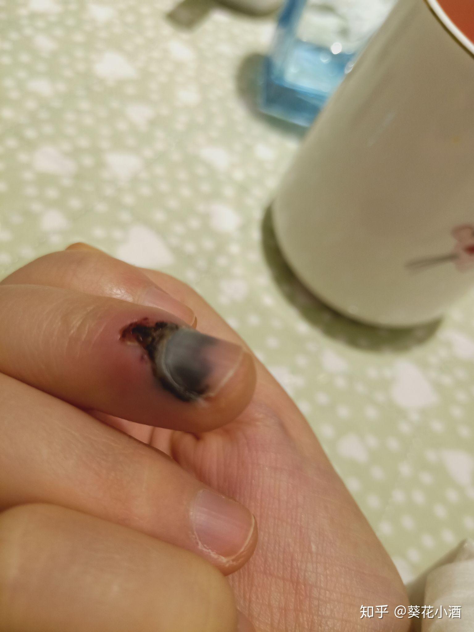 儿童手指被夹肿胀黑紫图片