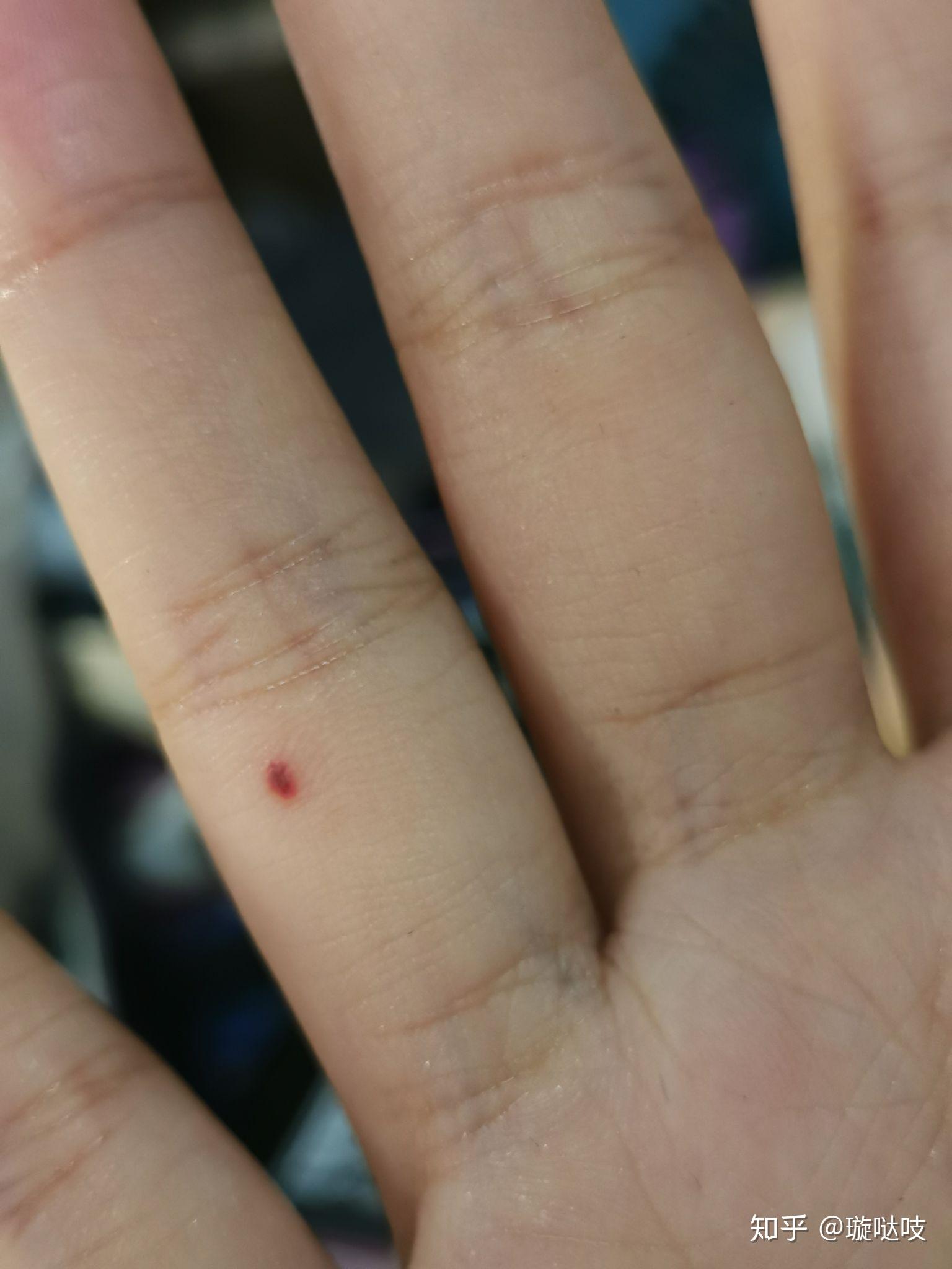 本人女左手无名指半年前多新长了一颗痣 有什么寓意? - 知乎