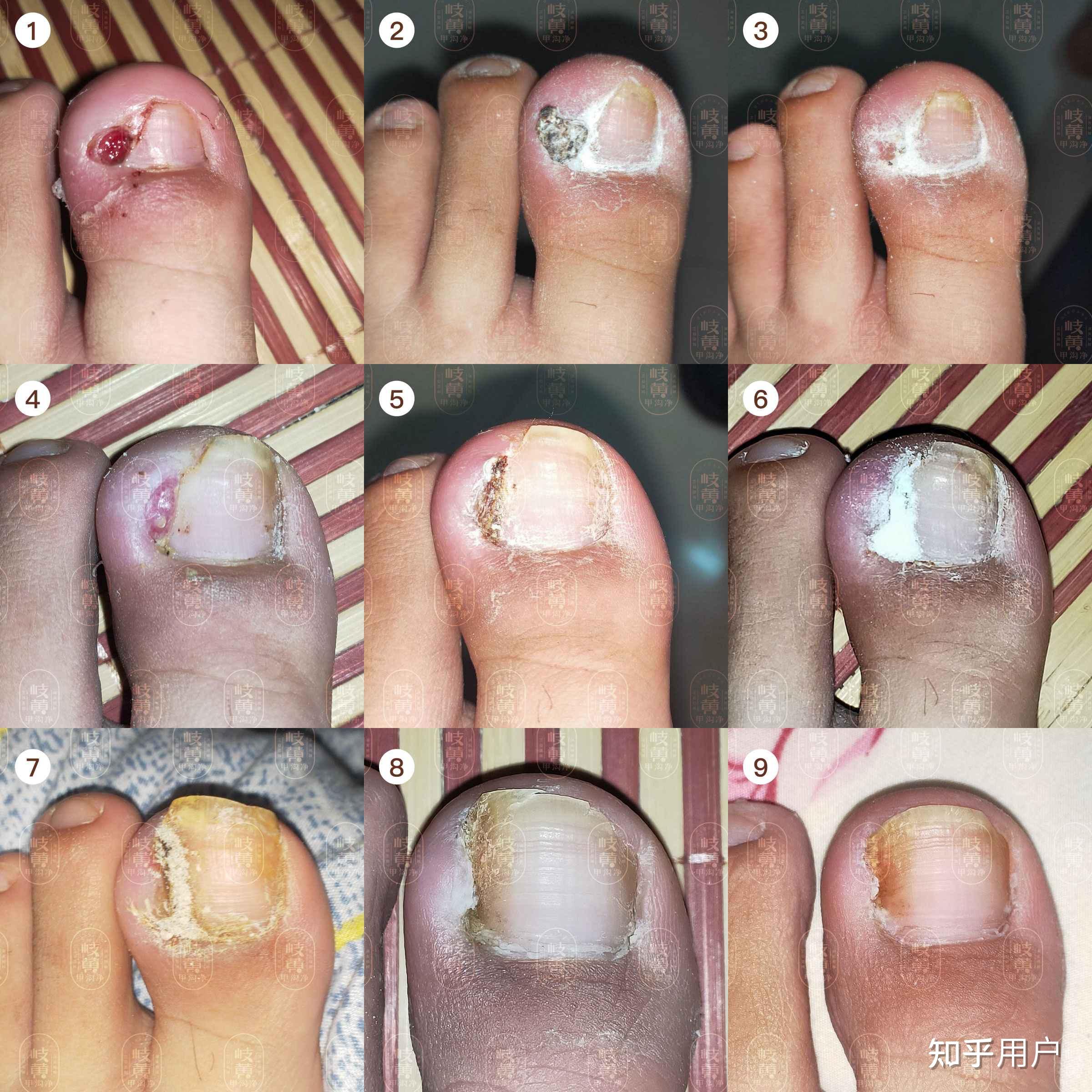 甲沟炎拔甲是怎样的体验? - 知乎