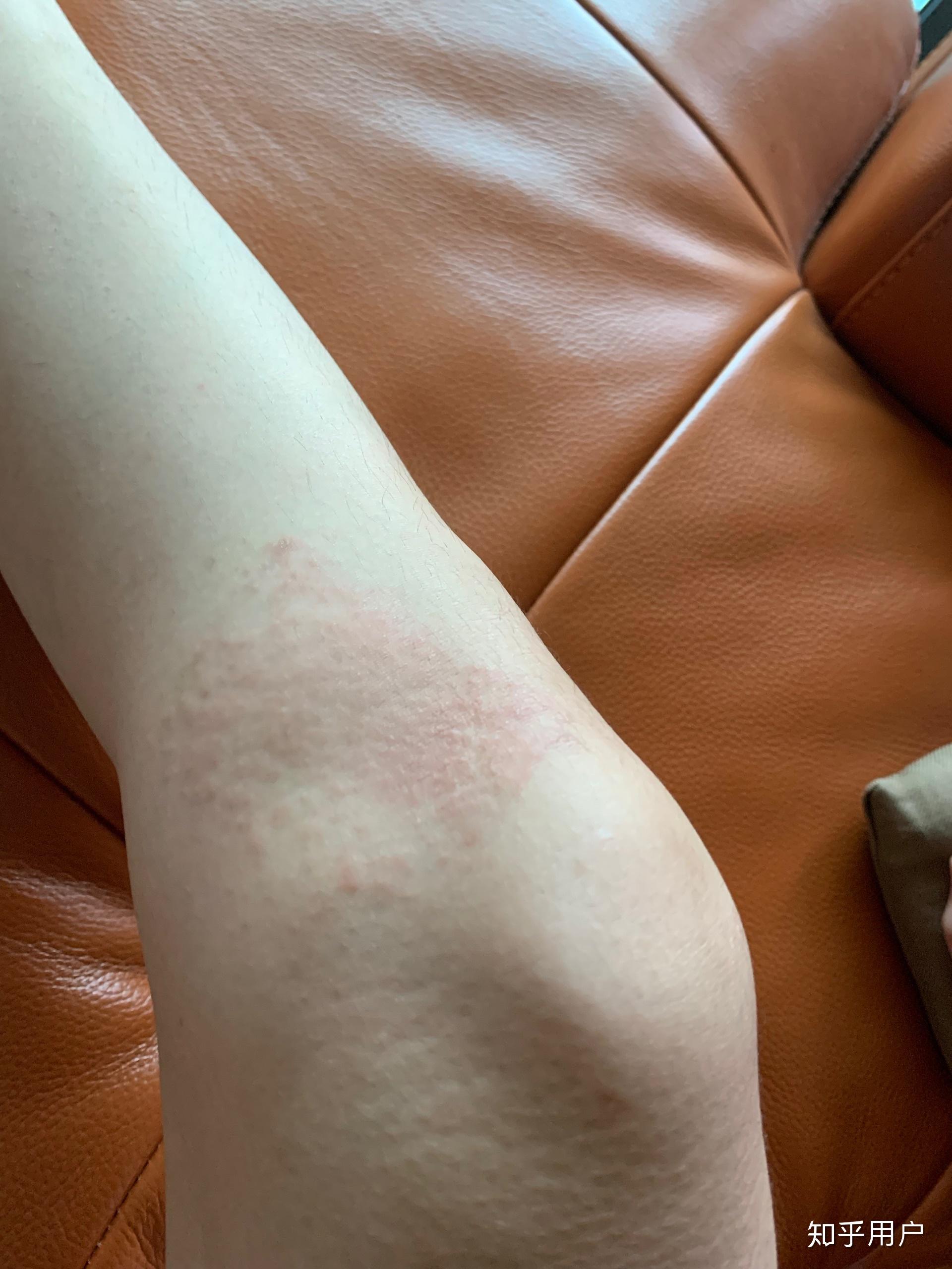 贴膏药过敏怎么办