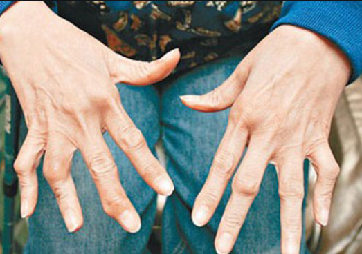 为什么绝大部分的类风湿患者会出现手指畸形