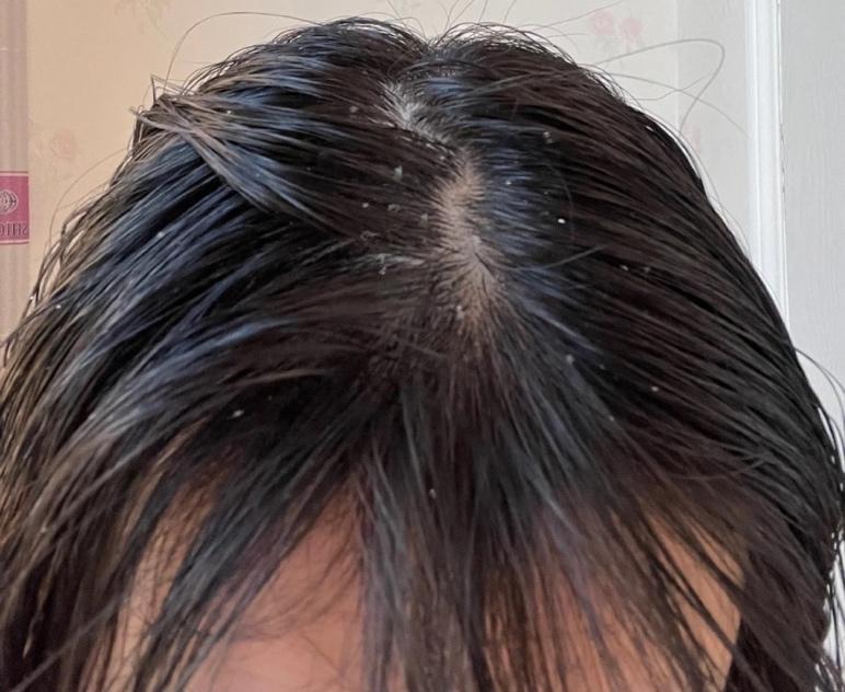 怎样有效减少头屑? - 知乎