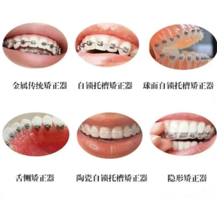 成年正畸丨牙套怎么选?牙齿矫正一套流程下来花多少钱? - 知乎