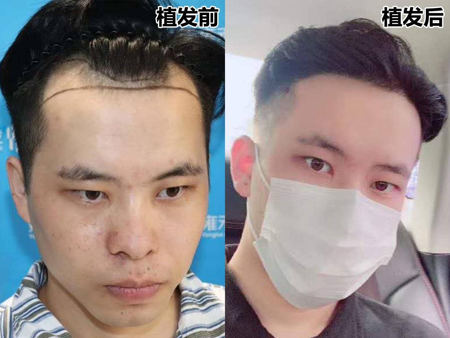 秃额角、发际线 高,适合什么发型? - 知乎