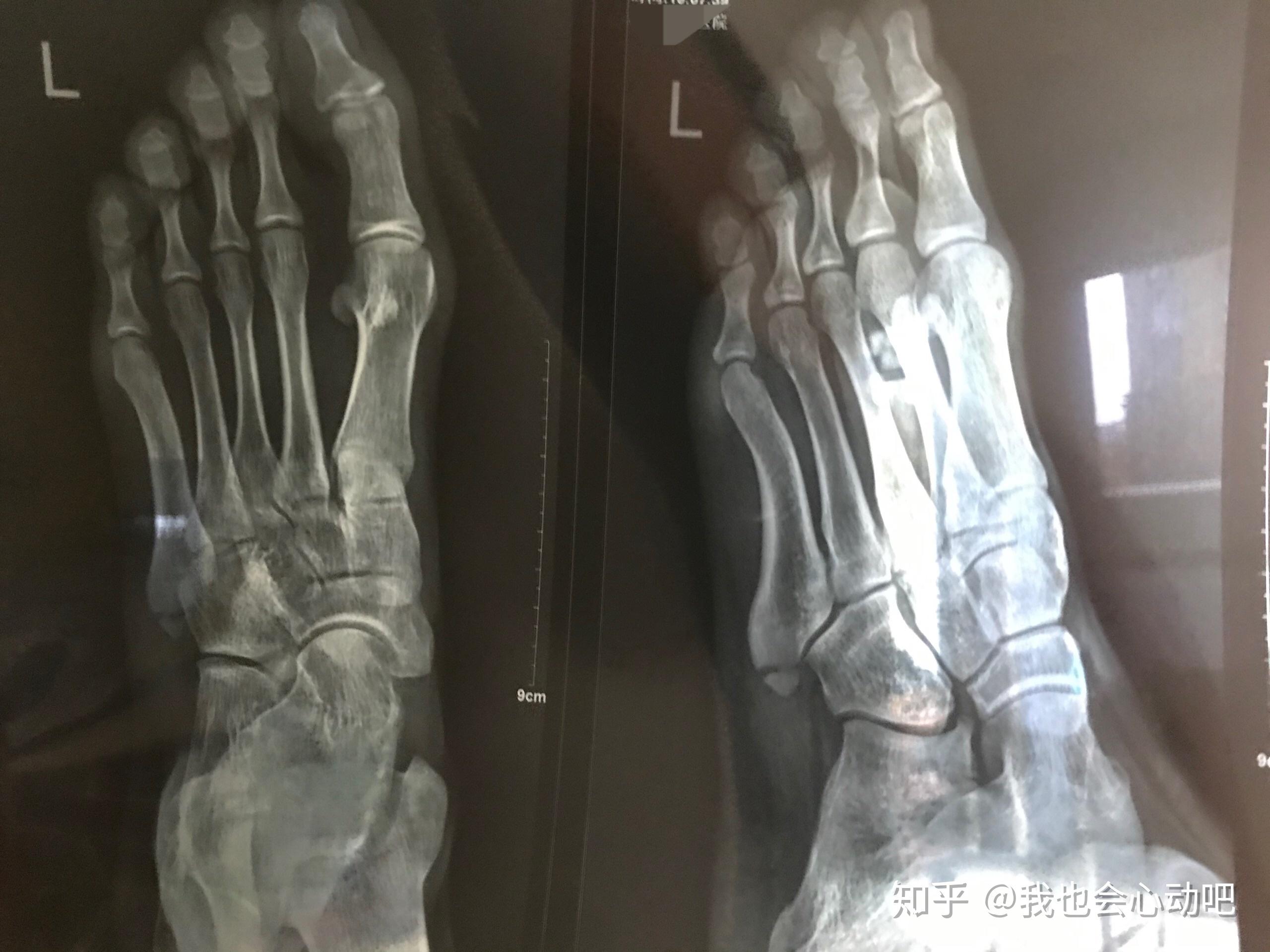 左脚第五跖骨基底部骨折需要几个月恢复?