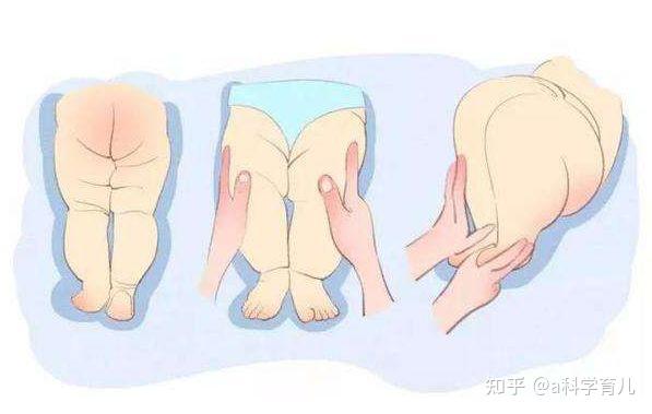 婴儿髋关节脱位?
