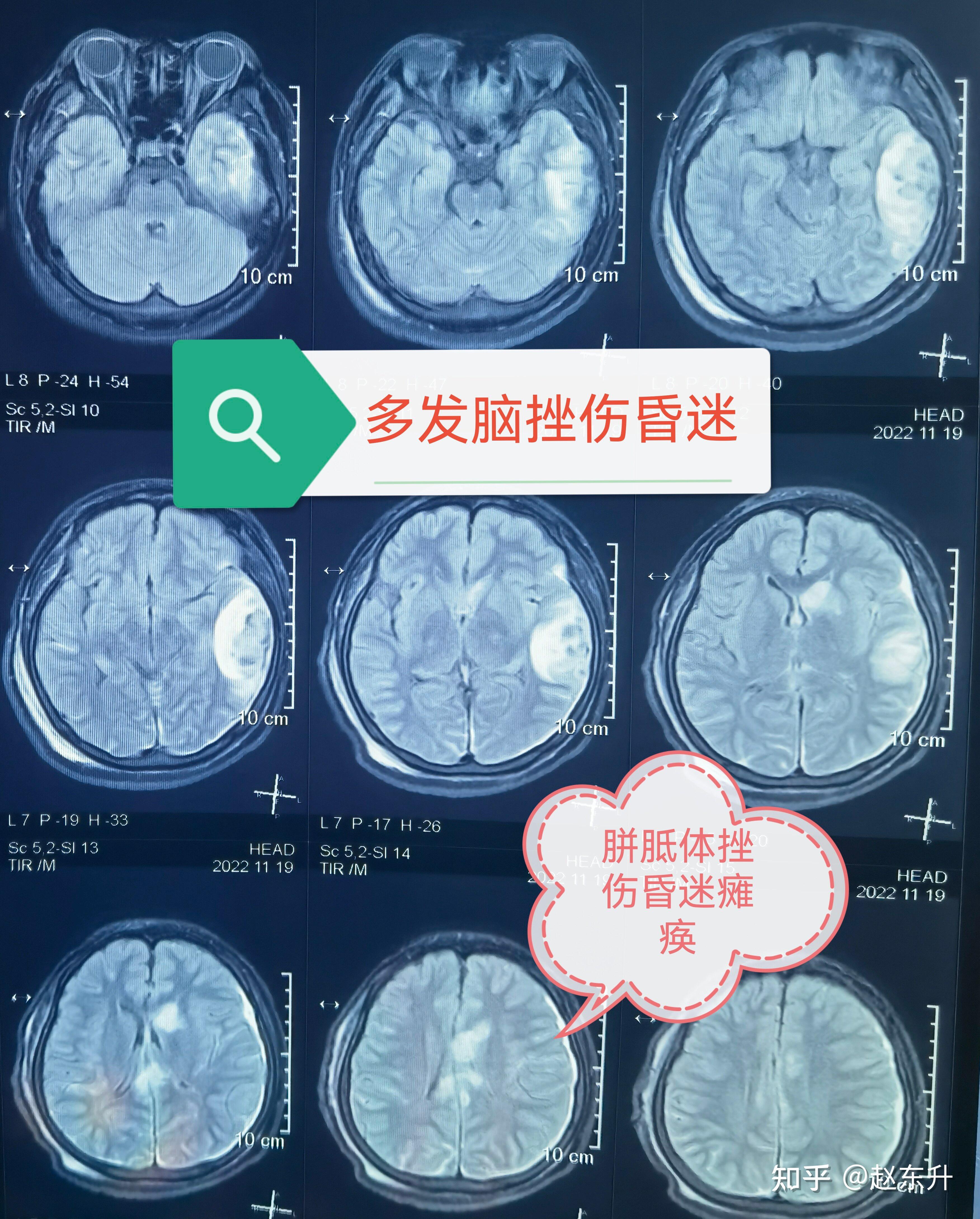 【疾病百科】放射性脑干损伤——早发现早治疗