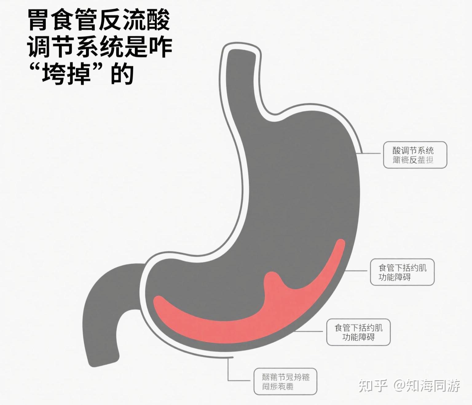 一直胃食管反流，到底是胃酸多还是胃酸少? - 知乎