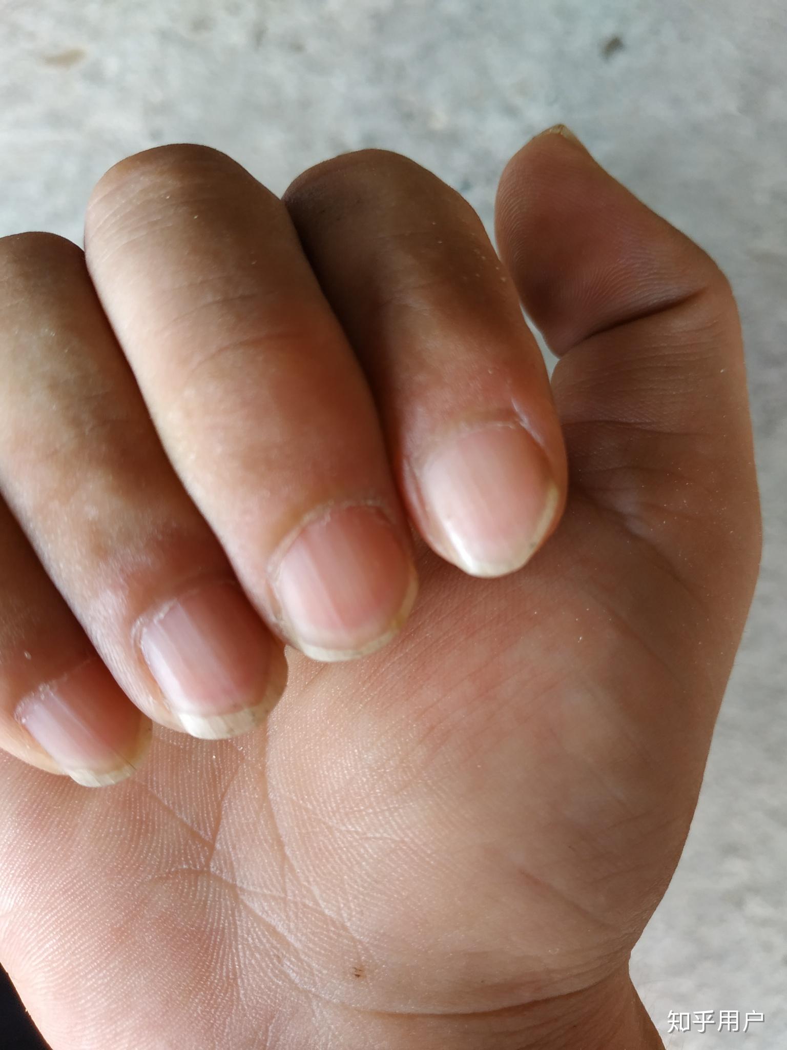 手指甲上面的月牙和人的健康状况有关系吗
