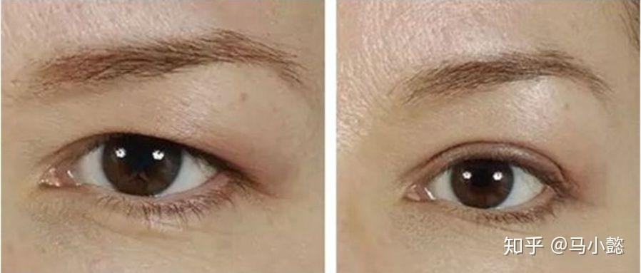 上眼睑下垂可以通过提拉改善吗