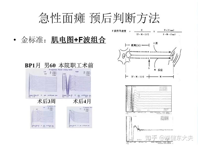 大家的面瘫都是第几天开始恢复啊