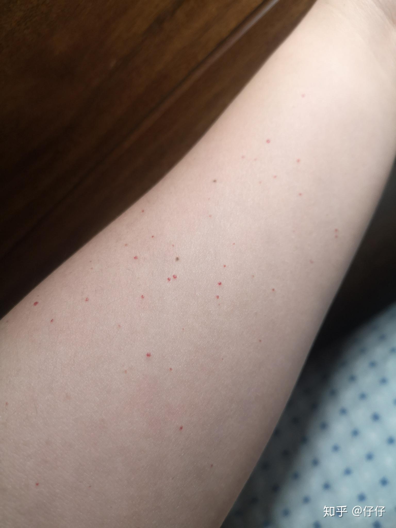 手臂上有不少好像因为血小板产生的小红点点