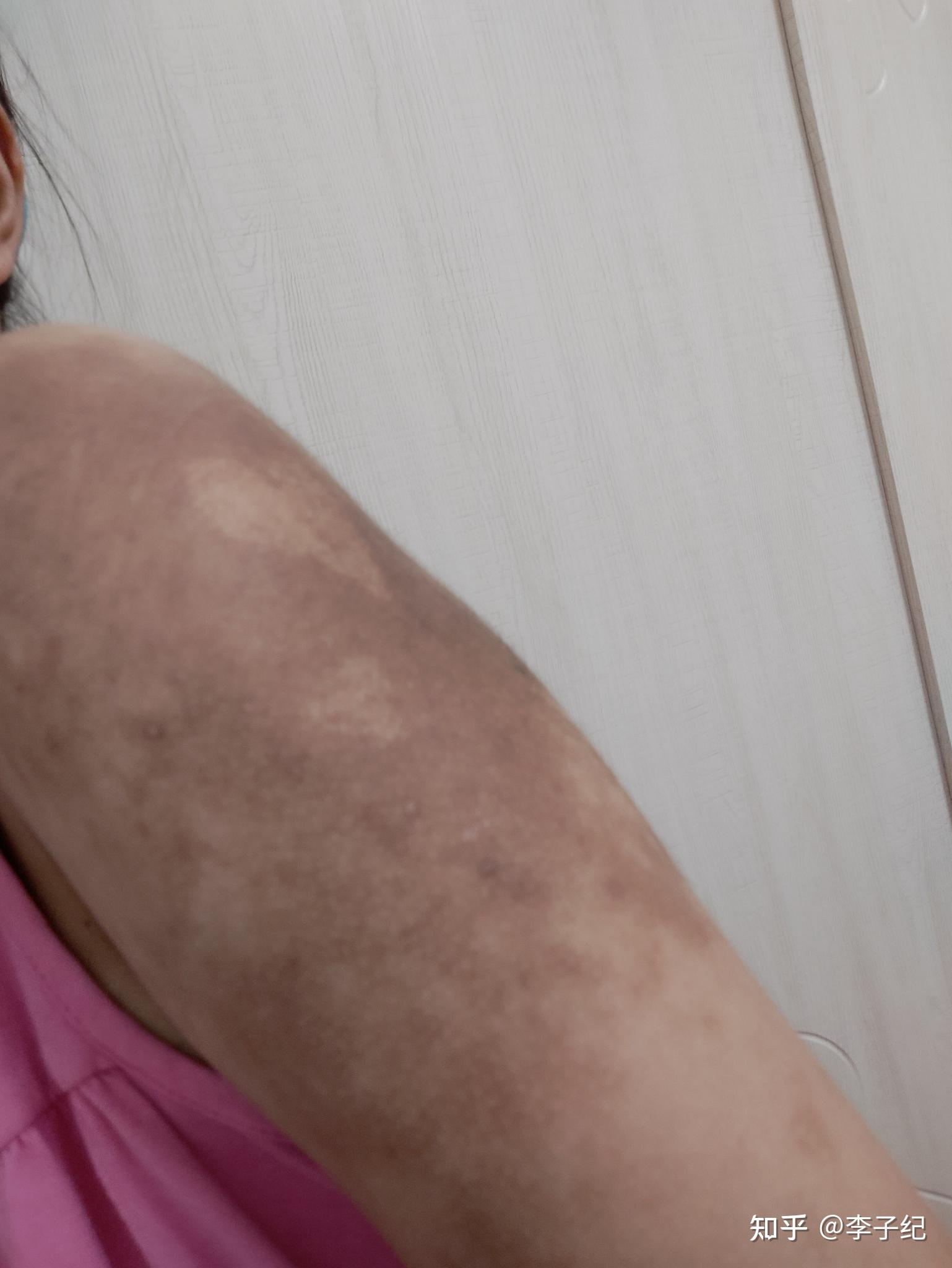 色素性毛表皮痣是一种怎样的病?能否治愈? - 知乎