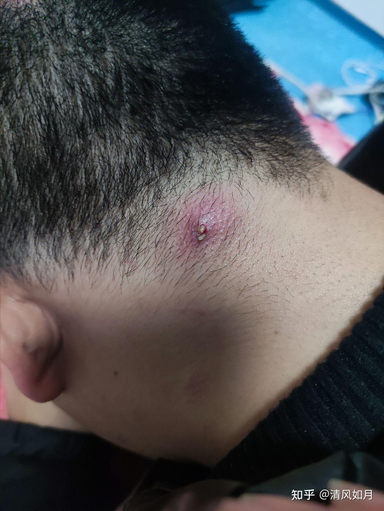 屁股上长个火疖子是什么感受