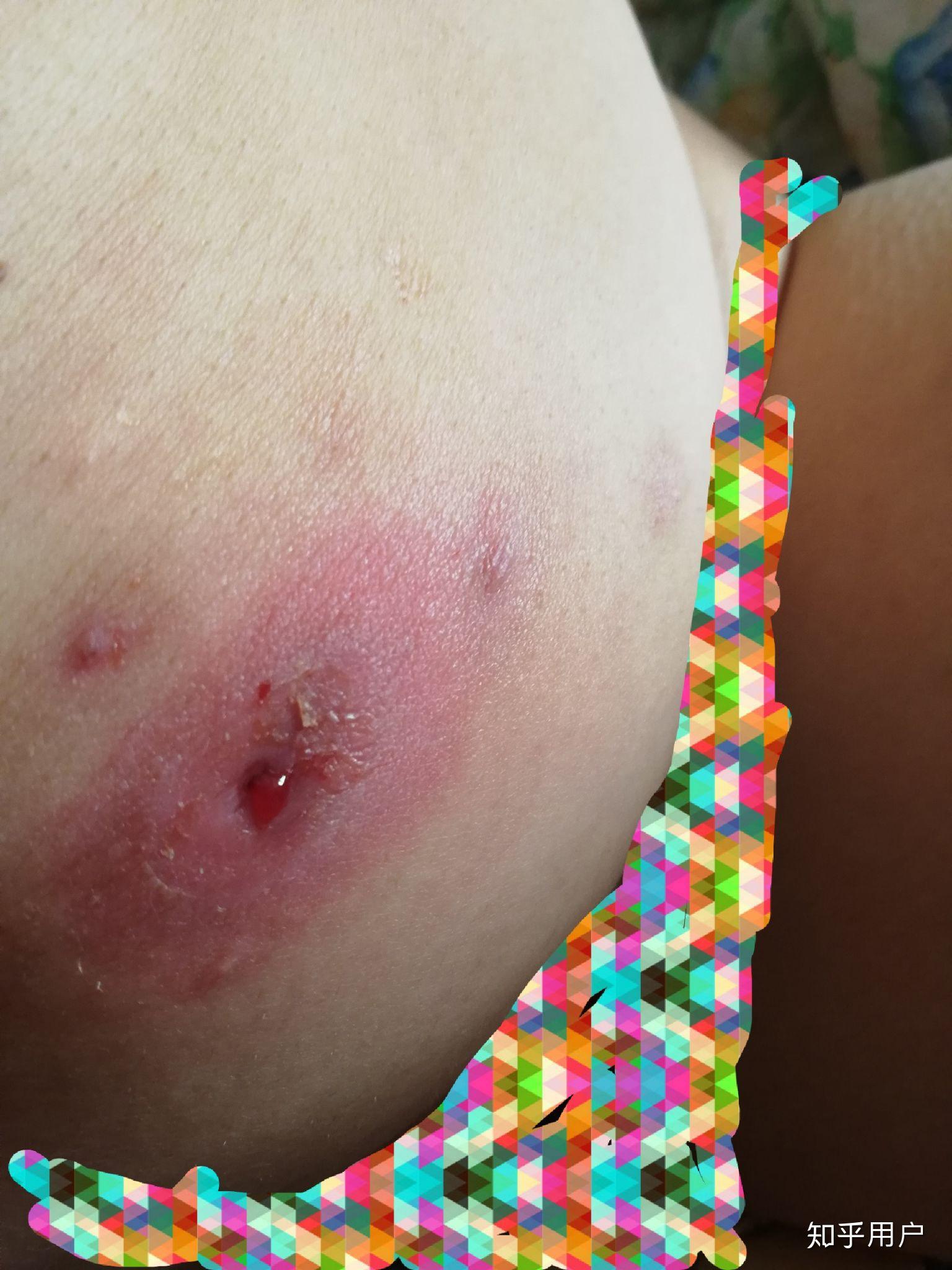 长火疖子怎么治很恐怖吗