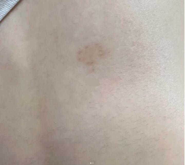 带状疱疹康复后的样子!