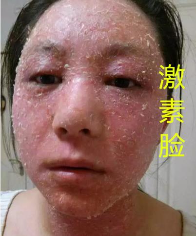 玫玫护肤老师激素脸修复为什么会反跳