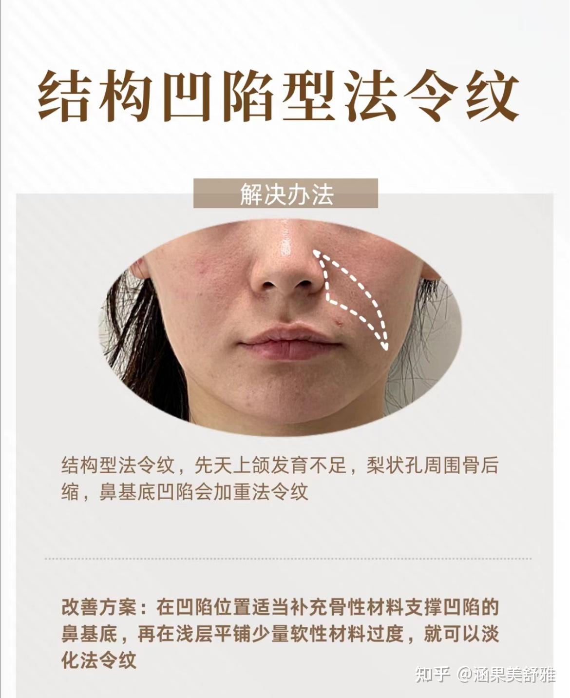 怎样改善法令纹? - 知乎
