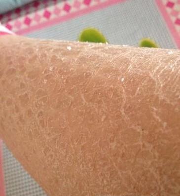 女孩洗澡洗出一身鱼鳞这种洗出来的皮肤病就在我们身边