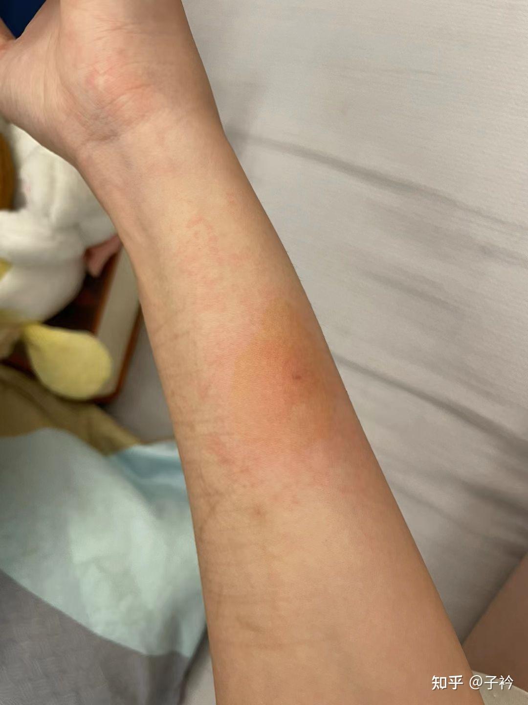 被蜘蛛咬了会有什么后果?