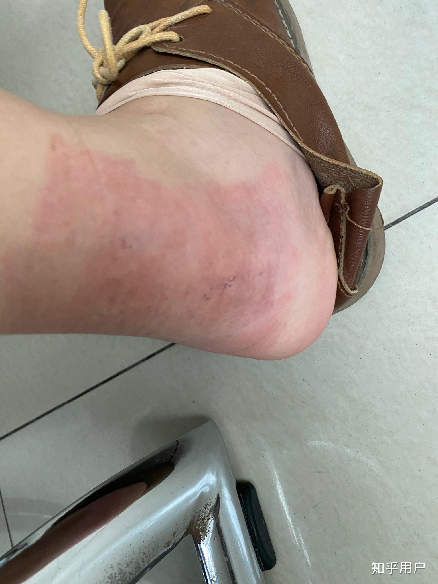 贴膏药过敏怎么办? - 知乎