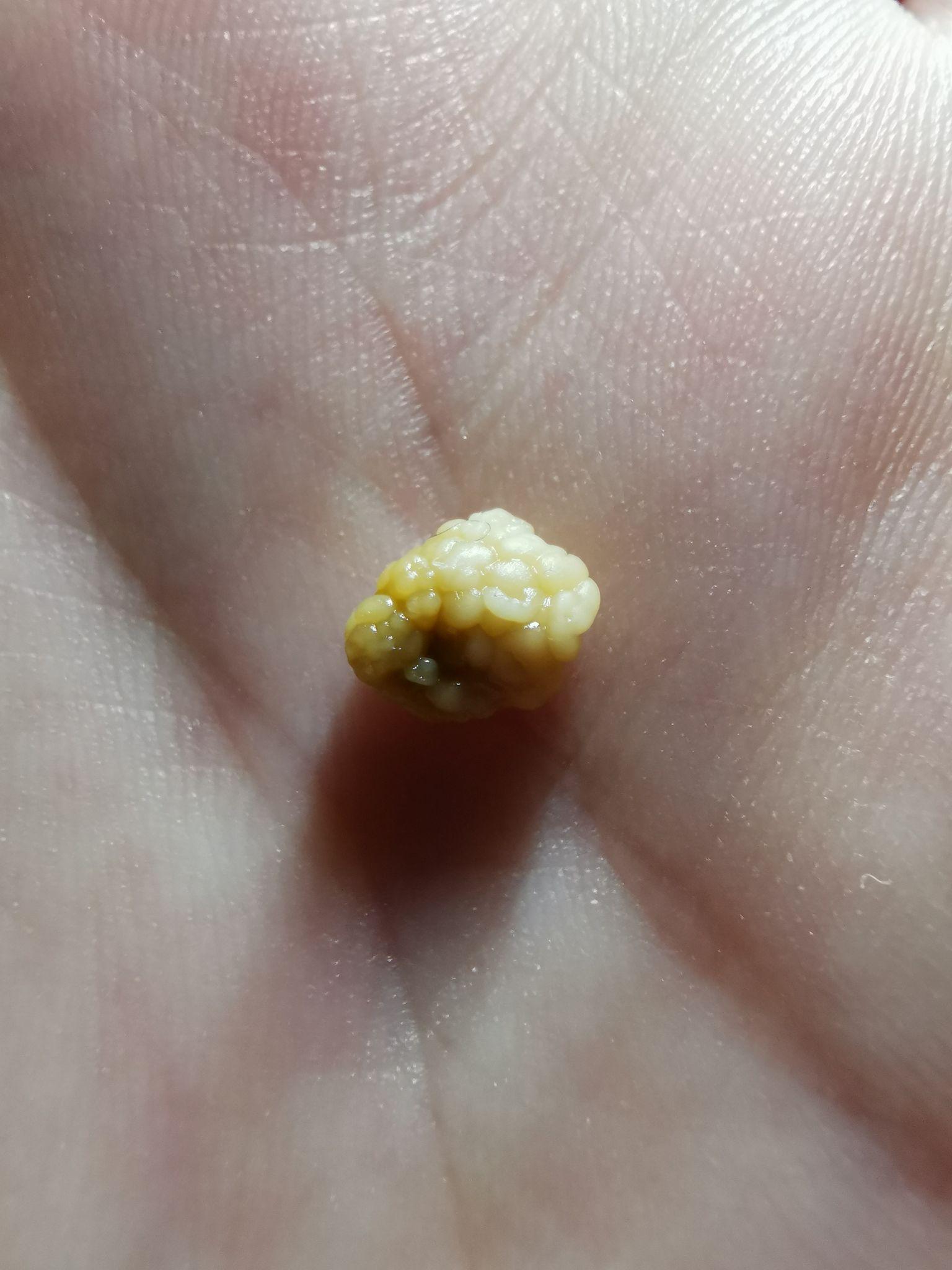 你见过最大的扁桃体结石有多大