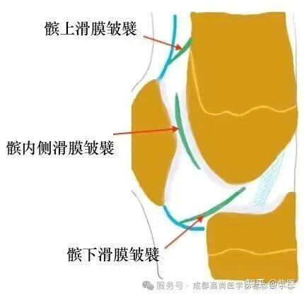 膝关节滑膜皱襞综合征(MPS)MR诊断 - 知乎