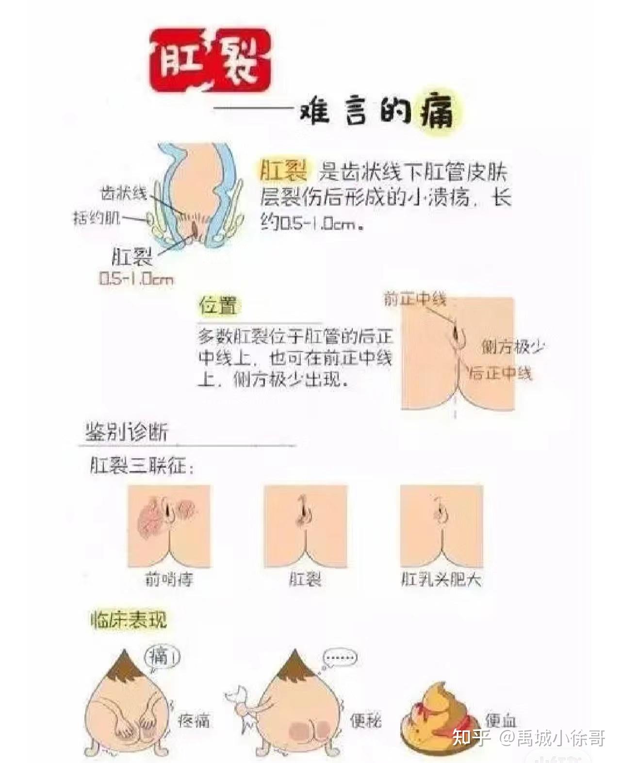 为什么肛裂还让扩肛不就裂开了吗百科在线 为什么肛裂还让扩肛不就裂开了吗百科在线