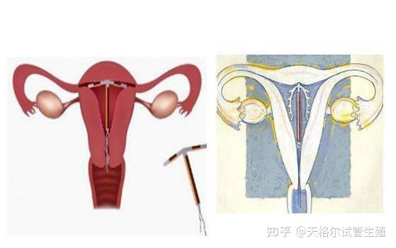 上曼月乐环后会更痛吗? - 知乎