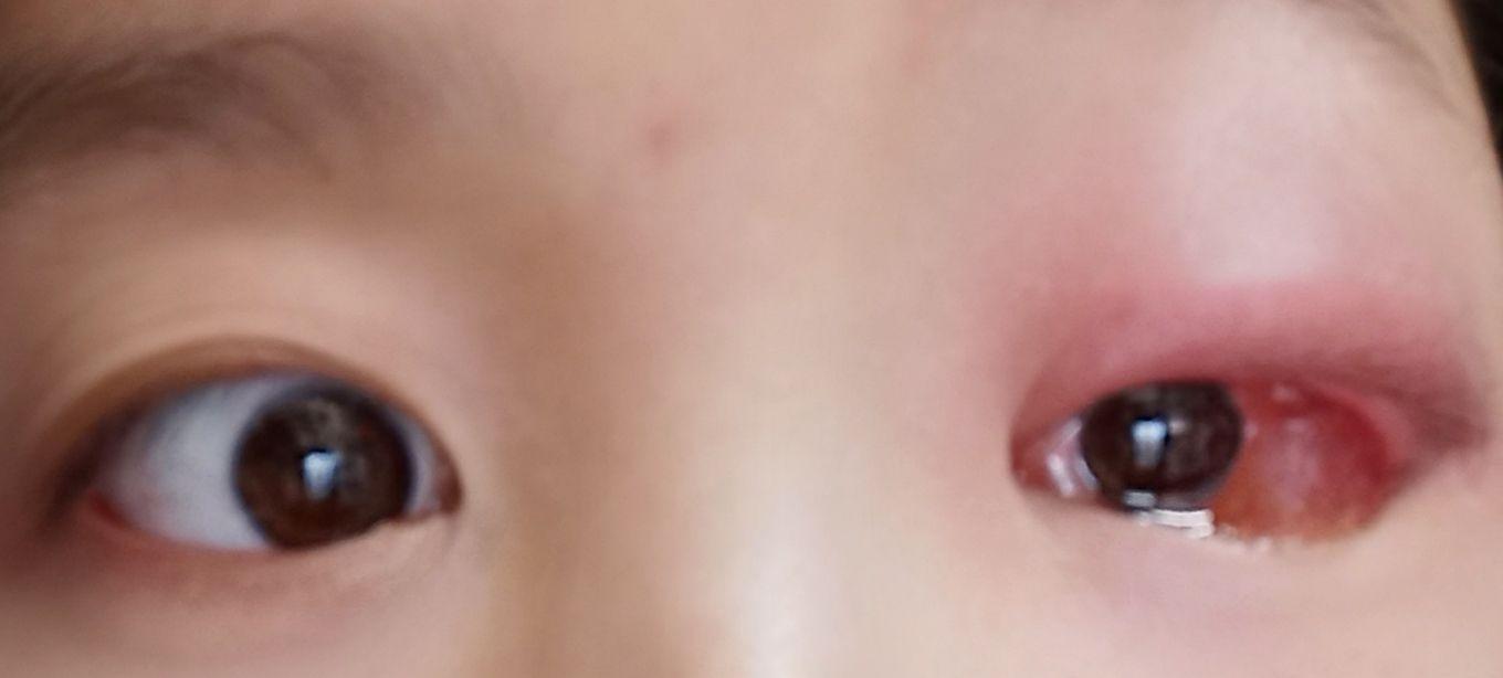 一只眼睛上眼皮和眼角突然肿了这是为什么