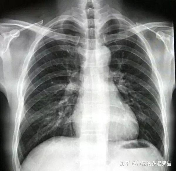 拍x光时,怎样会有影响? - 知乎
