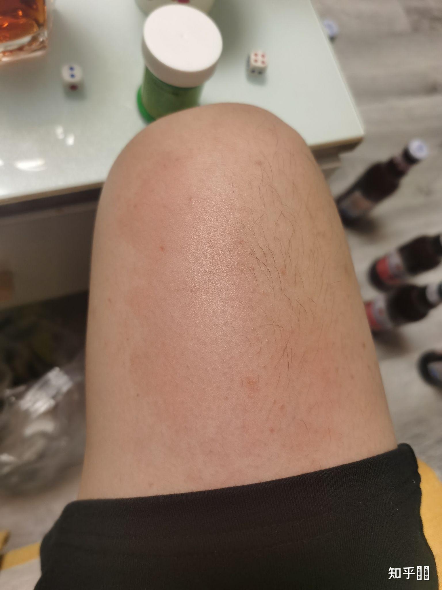 酒精过敏的反映会有哪些? - 知乎