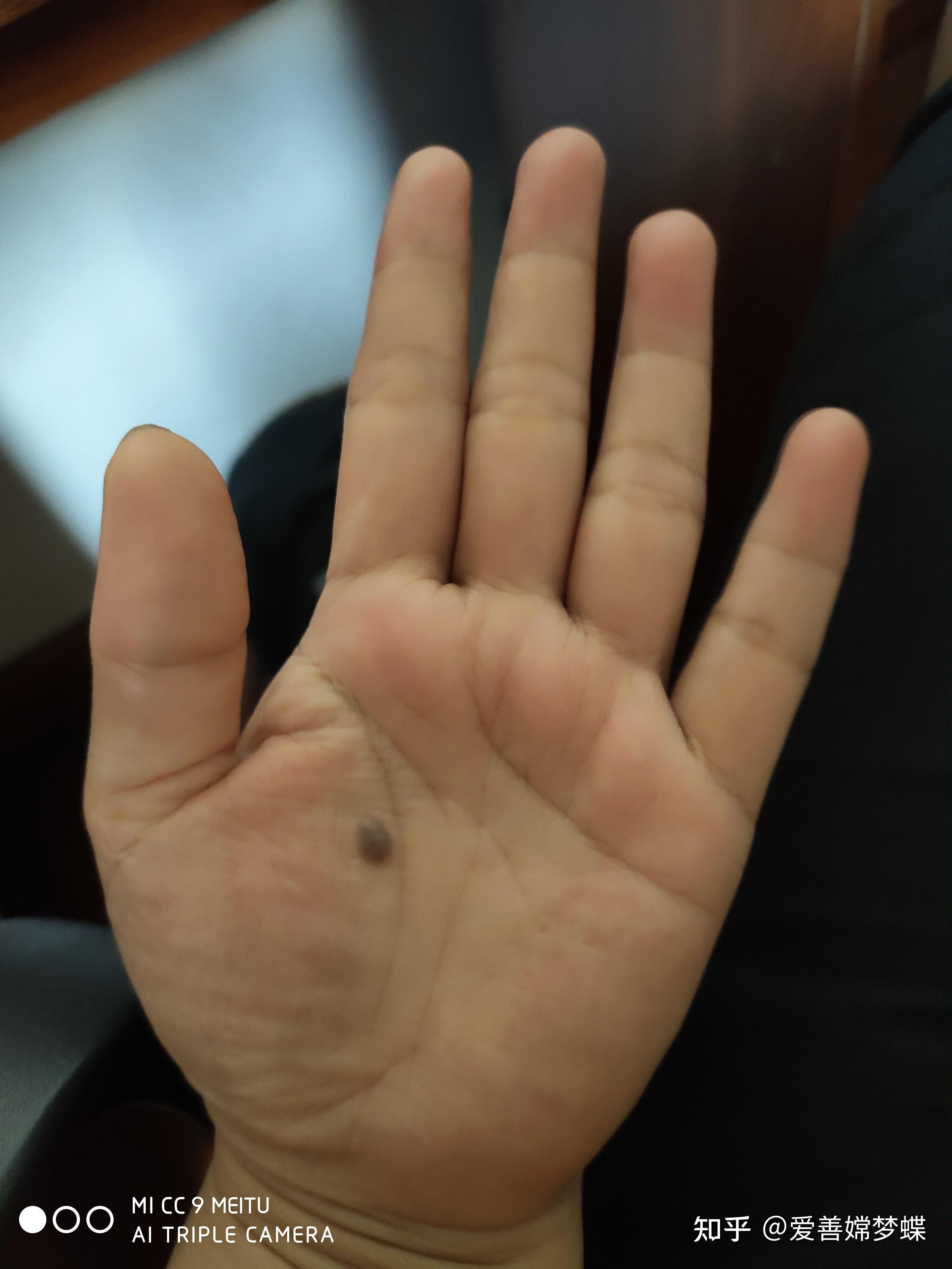你们手心里有痣吗?正中心?