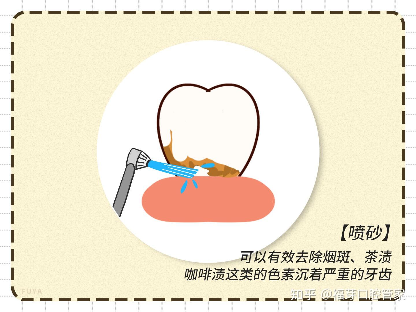 洗牙的过程是怎样的？洗牙后有哪些需要注意的？ 知乎 