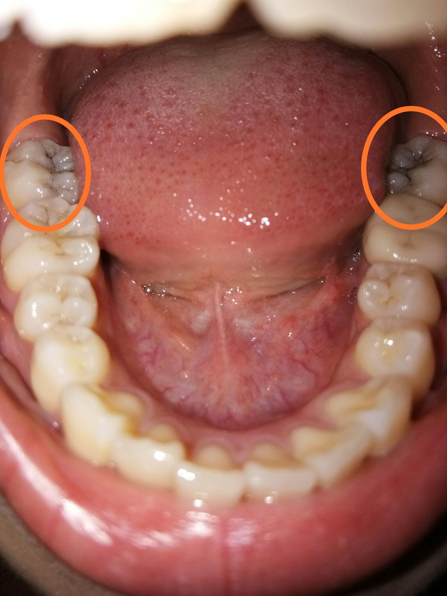 蛀牙,黑线? - 知乎