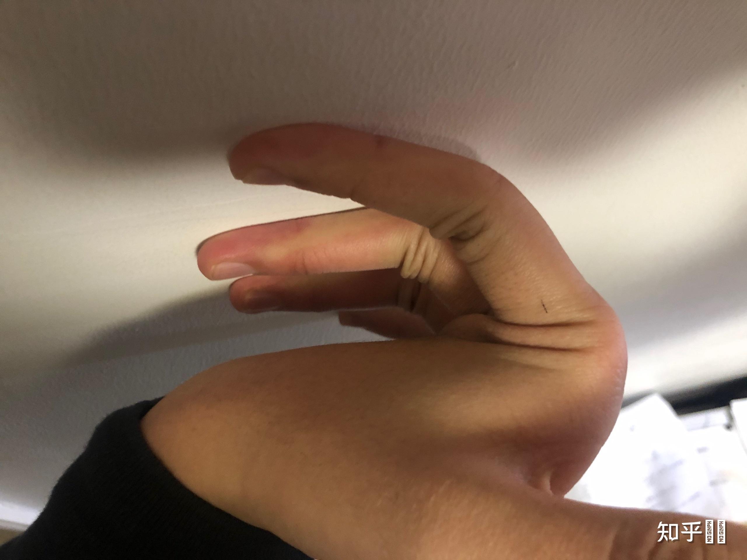 手指十个指头第一关节可反向弯曲90度正常吗