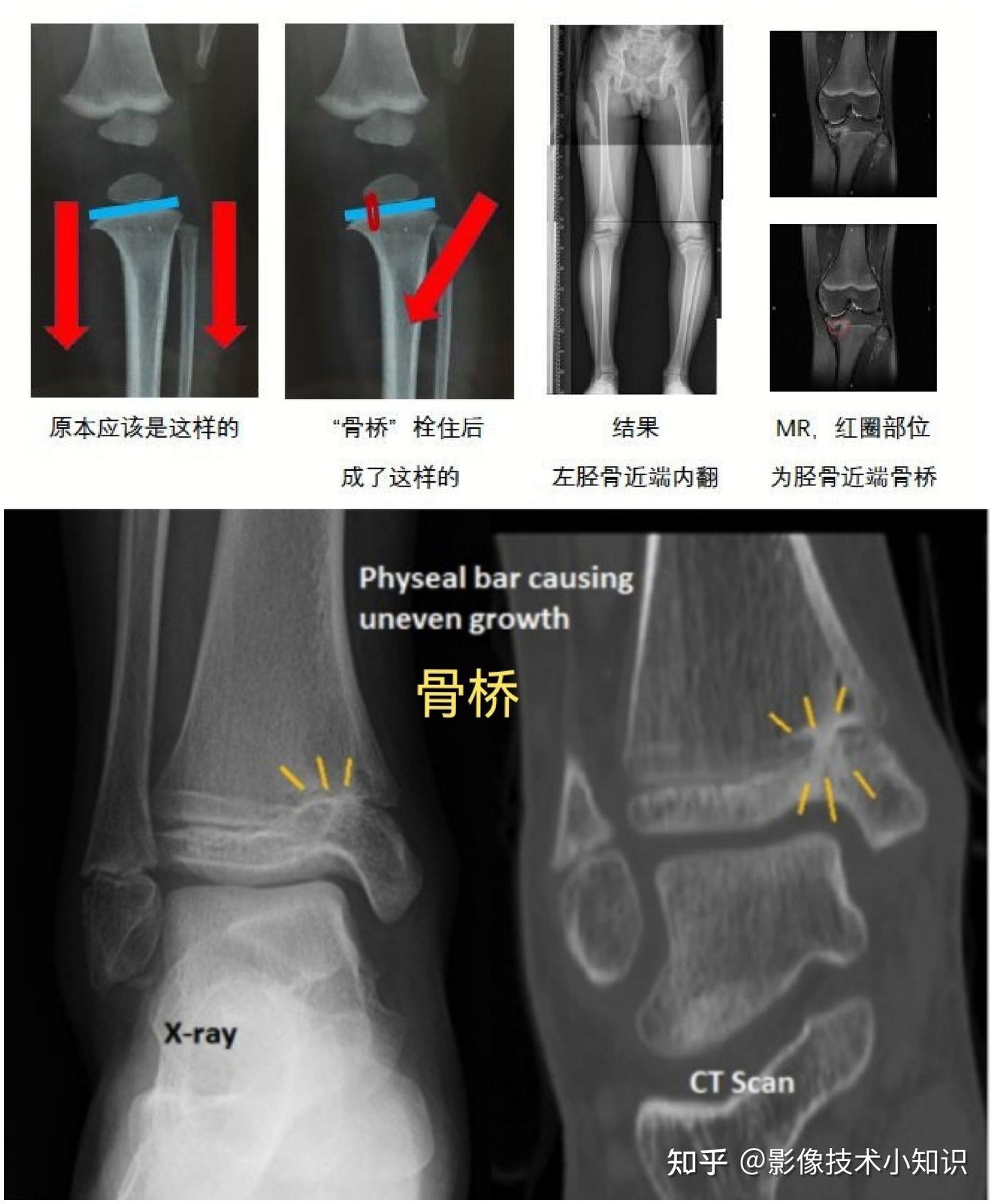 骨折影像诊断(2) - 知乎