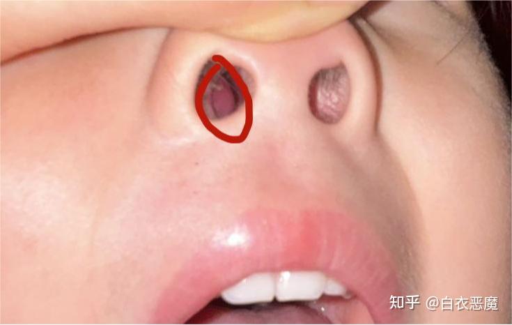 鼻孔里面肿了并出现白色脓包,周围红肿,应该怎么治疗?