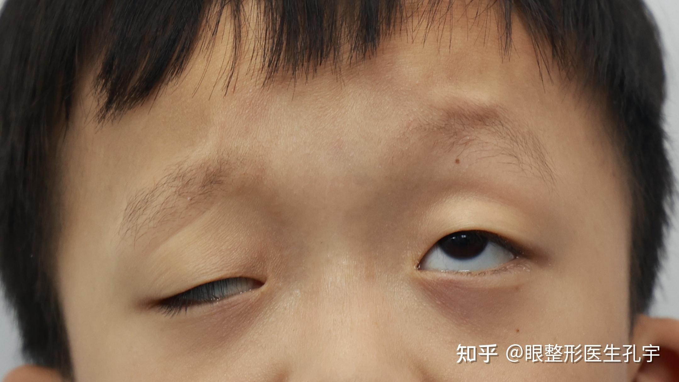 宝妈如何确定宝宝是否存在先天性上睑下垂